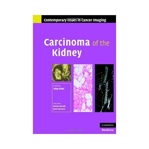 Carcinoma of the Kidney - Uday Patel